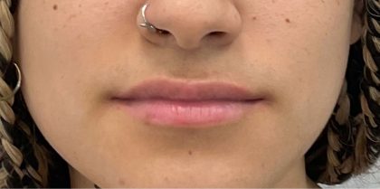 Lip Fillers Before & After Patient #2629