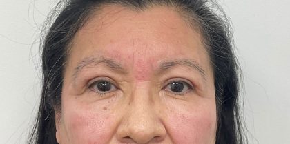 Blepharoplasty Before & After Patient #2623