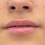 Lip Fillers Before & After Patient #2629