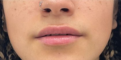 Lip Fillers Before & After Patient #2629
