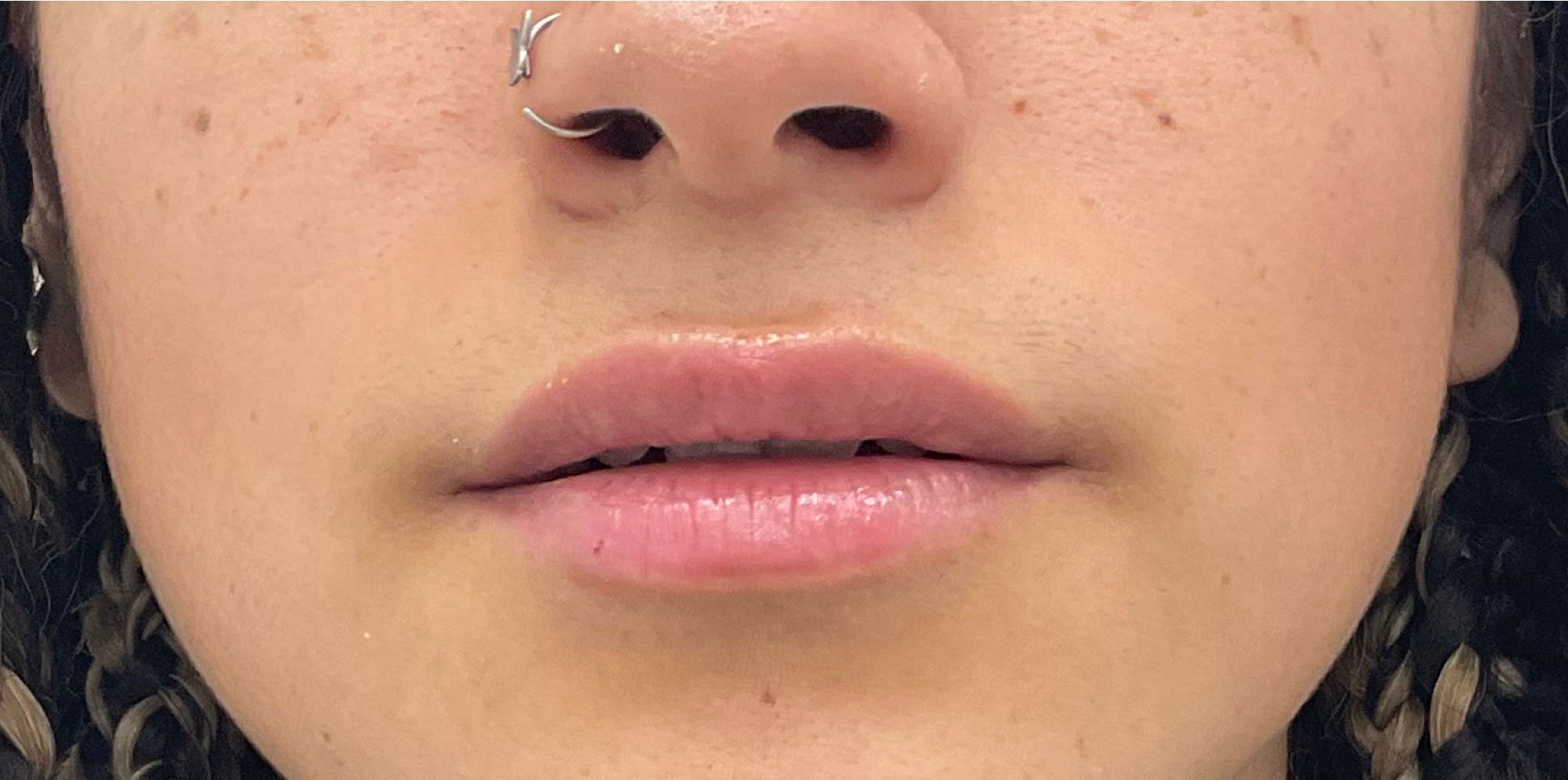 Lip Fillers Before & After Patient #2629