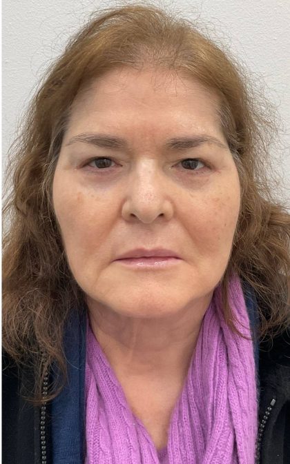 Lower Blepharoplasty Before & After Patient #2614