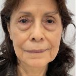 Blepharoplasty Before & After Patient #2620