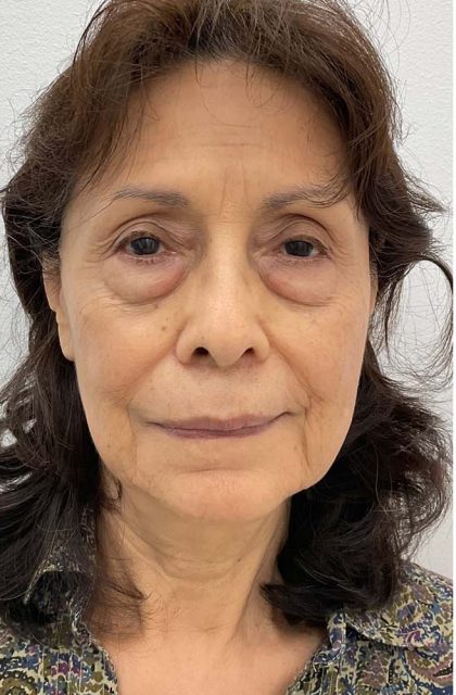 Blepharoplasty Before & After Patient #2620