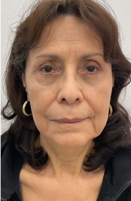 Blepharoplasty Before & After Patient #2620