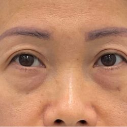 Lower Blepharoplasty Before & After Patient #2646
