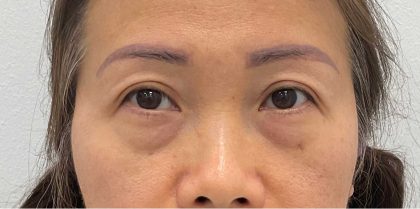 Lower Blepharoplasty Before & After Patient #2646
