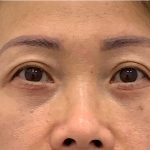 Lower Blepharoplasty Before & After Patient #2646