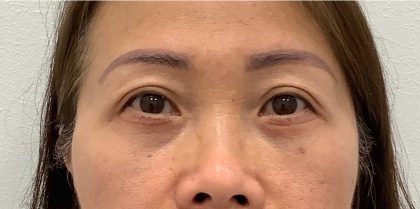 Lower Blepharoplasty Before & After Patient #2646