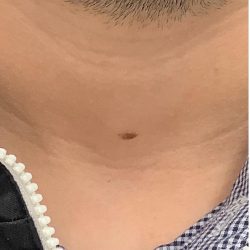 Mole Removal Before & After Patient #2649