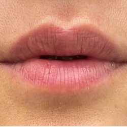 Lip Fillers Before & After Patient #2663