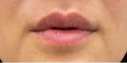 Lip Fillers Before & After Patient #2663