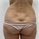 Liposculpture Before & After Patient #2666