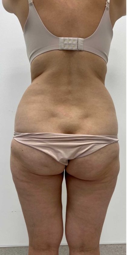 Liposculpture Before & After Patient #2666