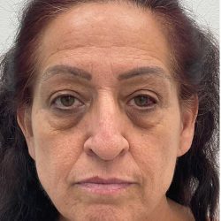 Lower Blepharoplasty Before & After Patient #2654