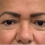 Blepharoplasty Before & After Patient #2698