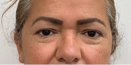 Blepharoplasty Before & After Patient #2698