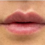 Lip Fillers Before & After Patient #2663
