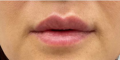 Lip Fillers Before & After Patient #2663