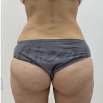 Liposculpture Before & After Patient #2666