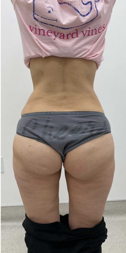 Liposculpture Before & After Patient #2666