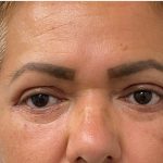 Blepharoplasty Before & After Patient #2698