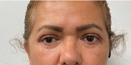 Blepharoplasty Before & After Patient #2698