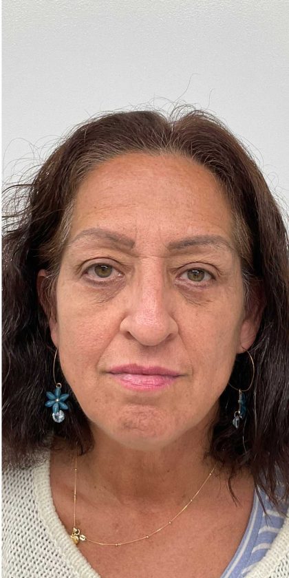 Lower Blepharoplasty Before & After Patient #2654