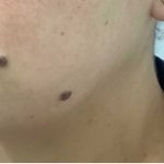 Mole Removal Before & After Patient #2657
