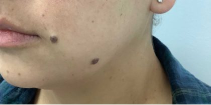 Mole Removal Before & After Patient #2657