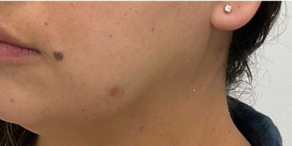 Mole Removal Before & After Patient #2657