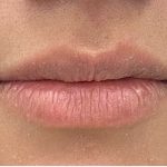 Lip Fillers Before & After Patient #2658