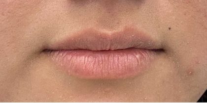 Lip Fillers Before & After Patient #2658
