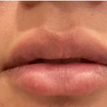 Lip Fillers Before & After Patient #2658