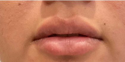 Lip Fillers Before & After Patient #2658