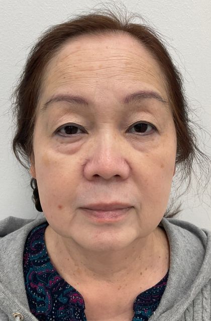 Blepharoplasty Before & After Patient #2694