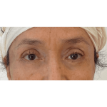 Blepharoplasty Before & After Patient #2825