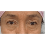Blepharoplasty Before & After Patient #2825