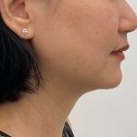 Kybella Before & After Patient #2830