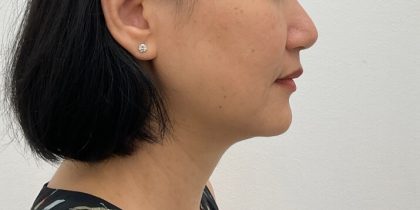 Kybella Before & After Patient #2830