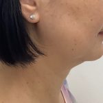 Kybella Before & After Patient #2830