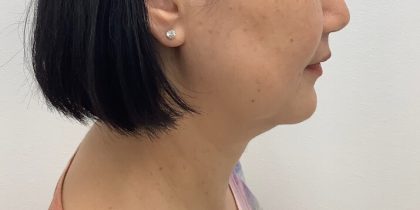 Kybella Before & After Patient #2830