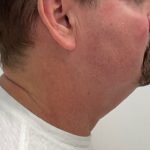 Kybella Before & After Patient #2822