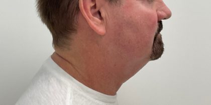 Kybella Before & After Patient #2822