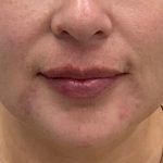 Lip Fillers Before & After Patient #2833