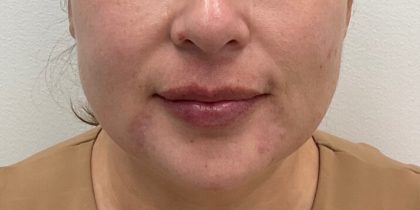 Lip Fillers Before & After Patient #2833