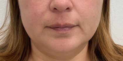 Lip Fillers Before & After Patient #2833