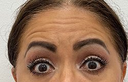Botox Before & After Patient #2910