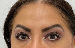 Botox Before & After Patient #2910