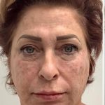 Skincredible 360 Before & After Patient #2909